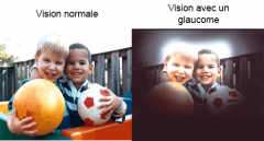 Glaucome