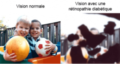 Rétinopathie diabètique