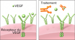 Traitment de la DMLA par anti VEGF