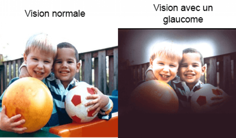 Glaucome