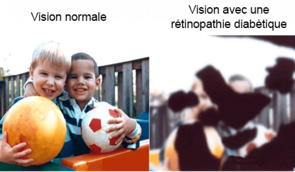 Rétinopathie diabètique