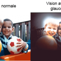 Glaucome