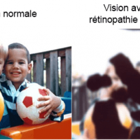 Rétinopathie diabètique